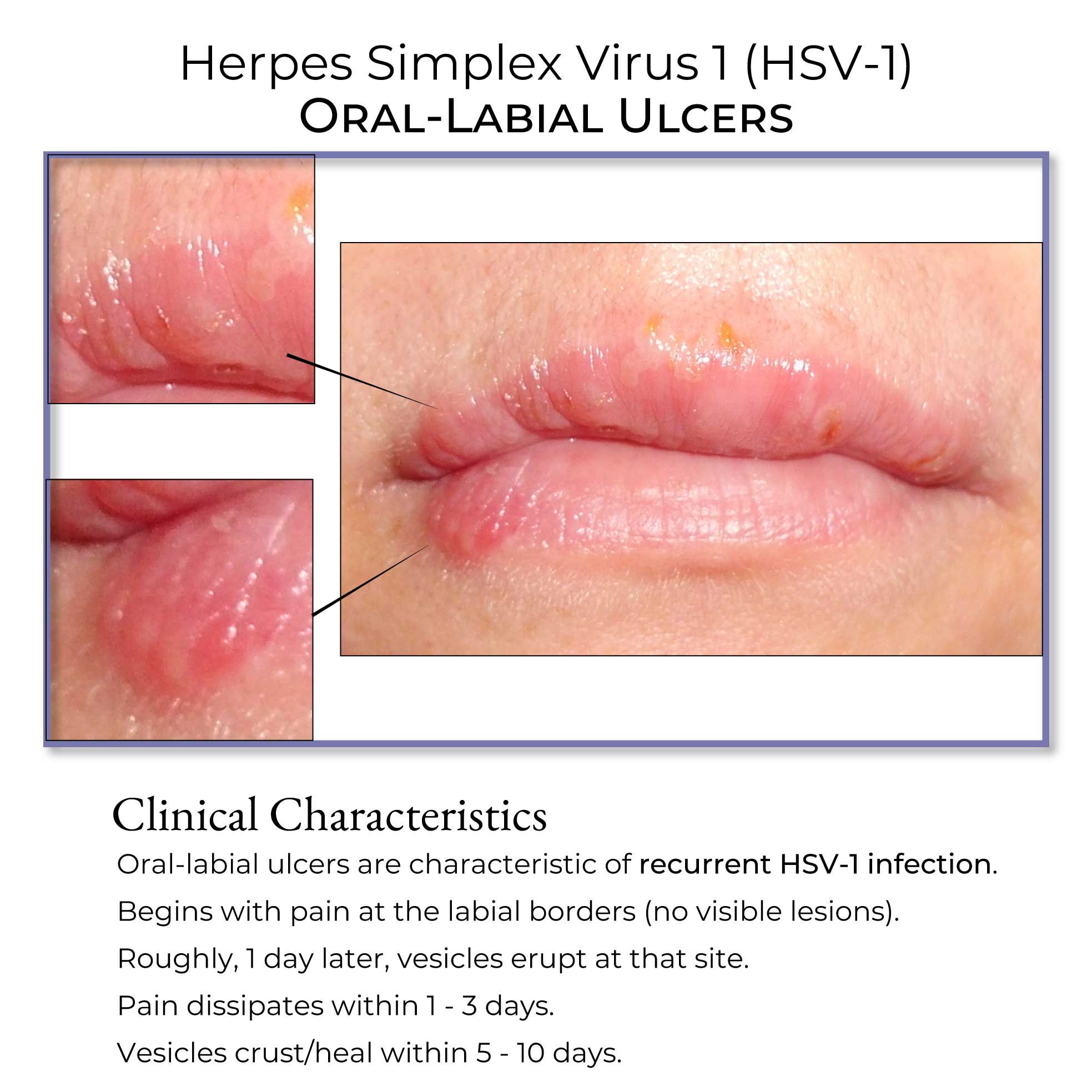 HSV-1 oral blister