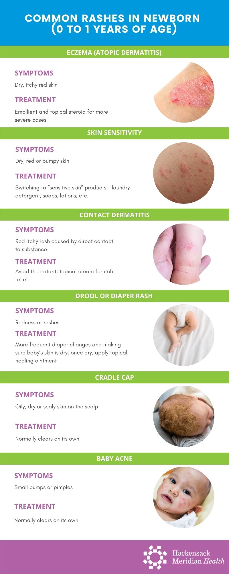 baby fever rash symptoms