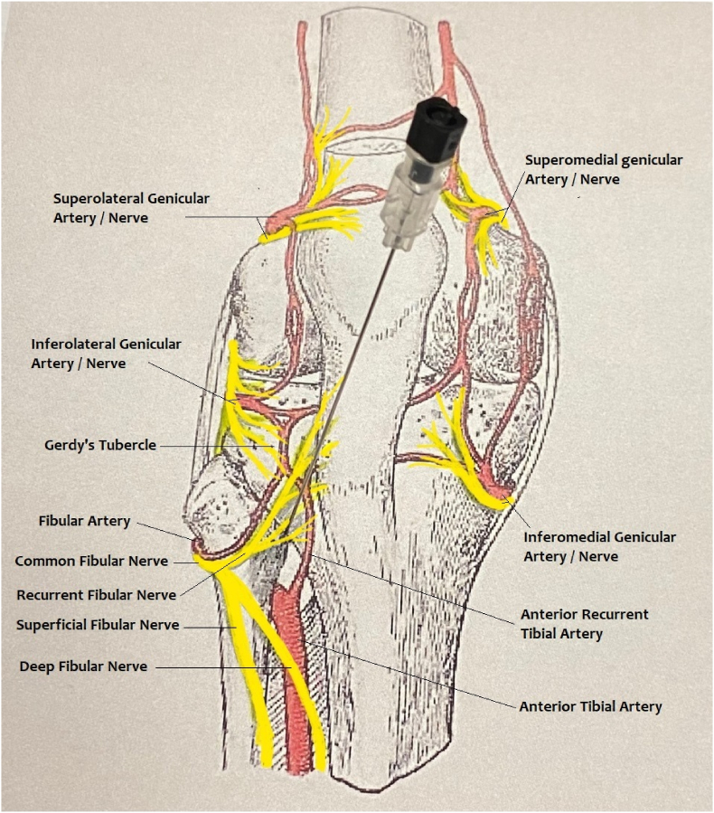 genicular nerve ablation procedure