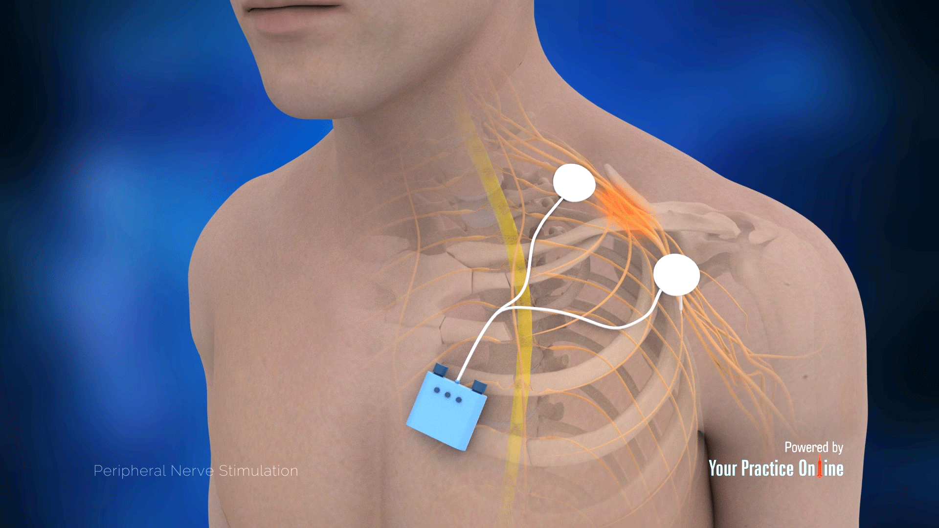 peripheral nerve stimulation device