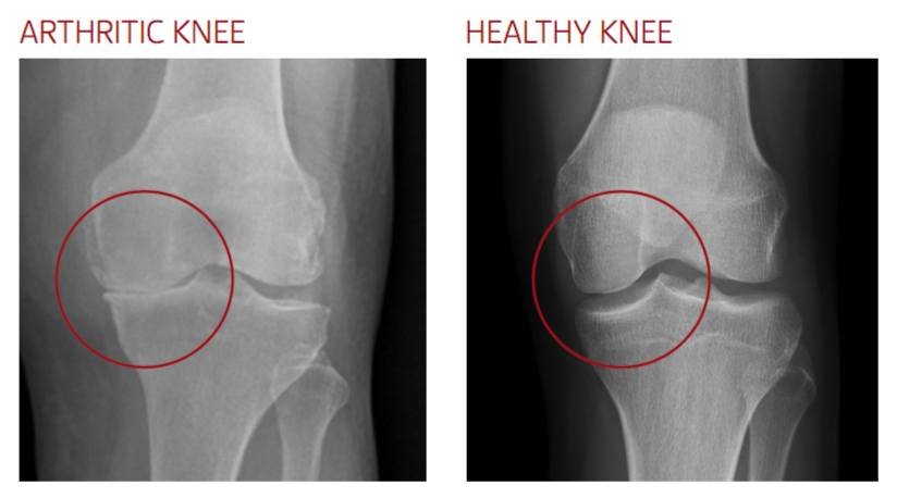 knee arthritis x-ray imaging