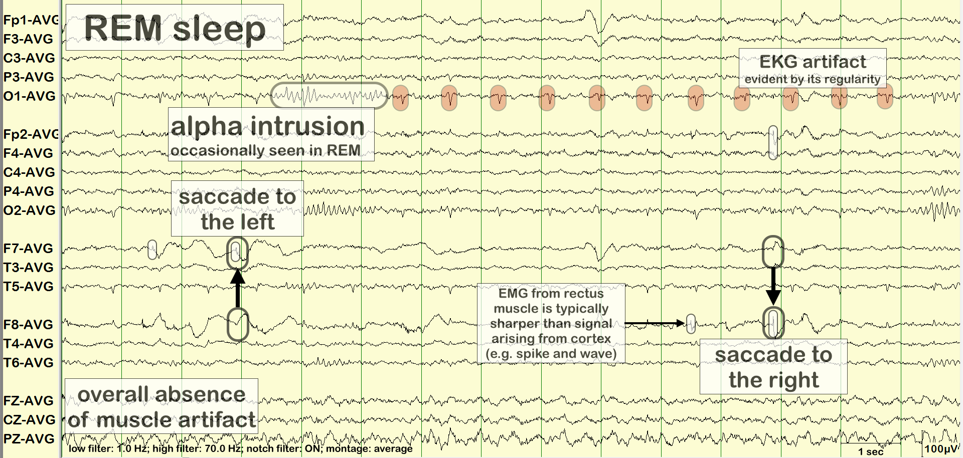 REM sleep intrusion