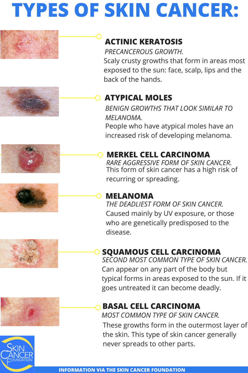 Rare Skin Cancer Mistaken for Vitamin Deficiency for 8 Years