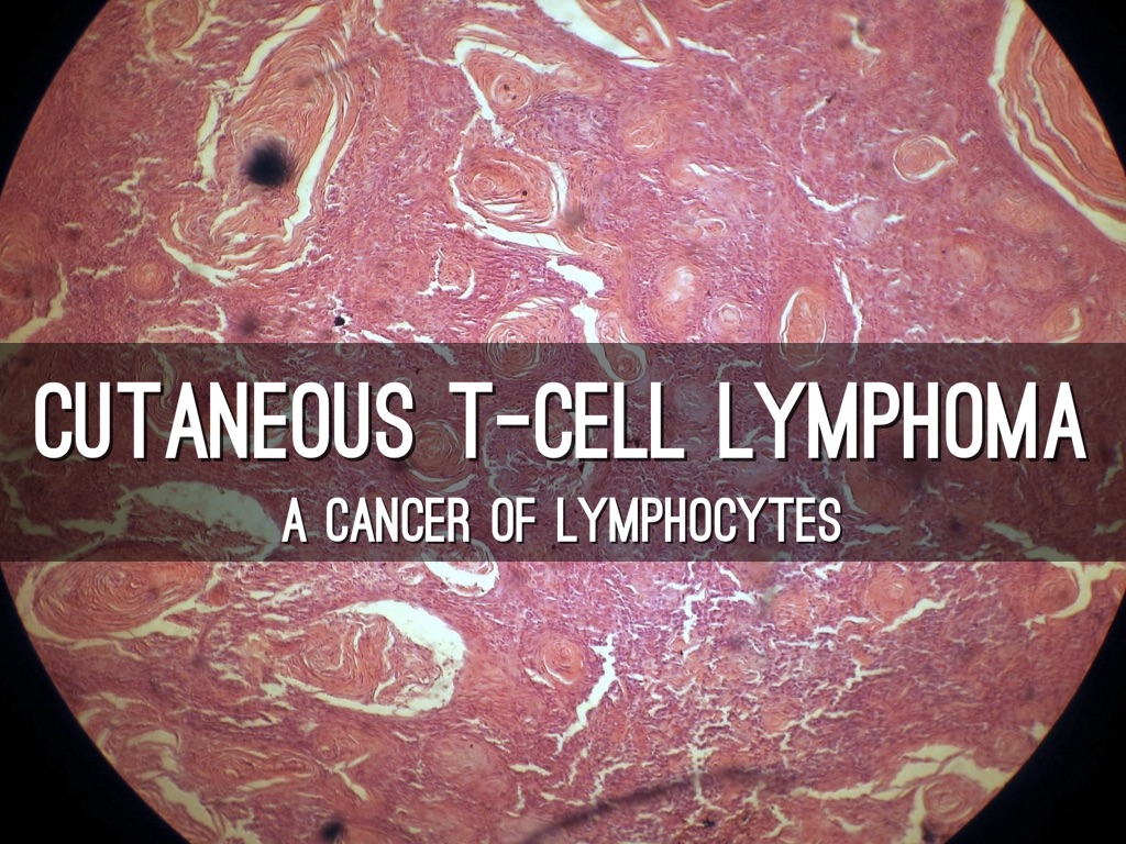 cutaneous T-cell lymphoma