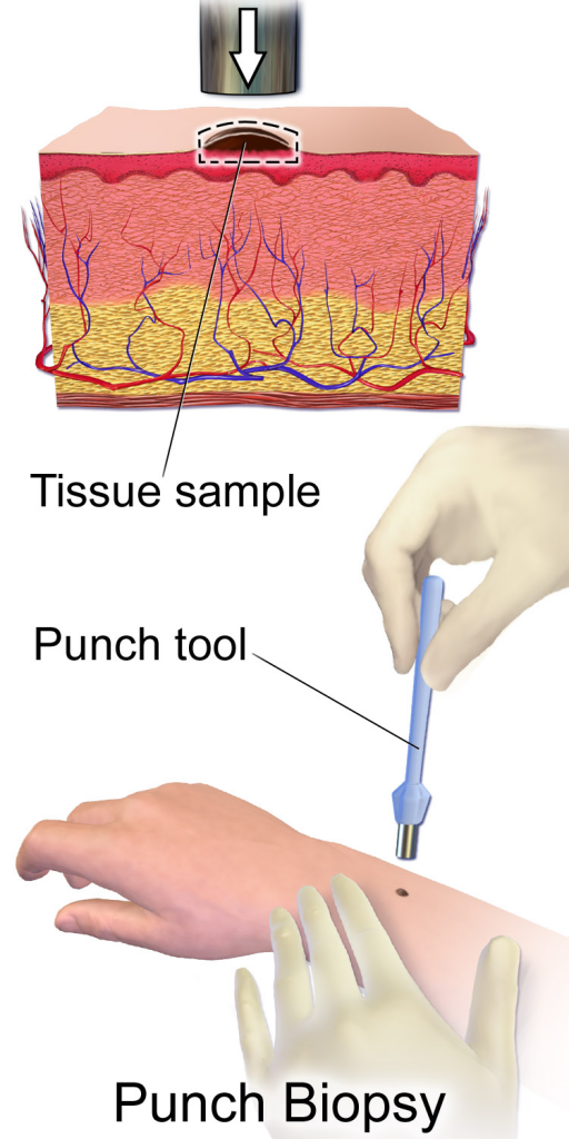 skin biopsy dermatology