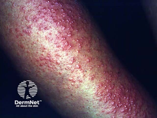photosensitive dermatitis rash