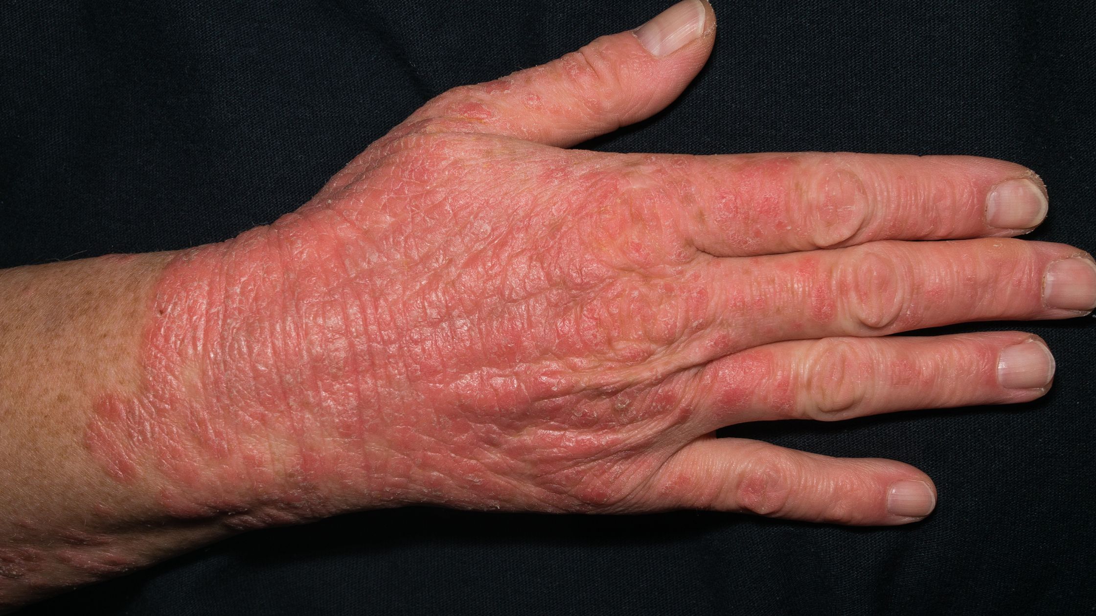 chronic scaly skin patch