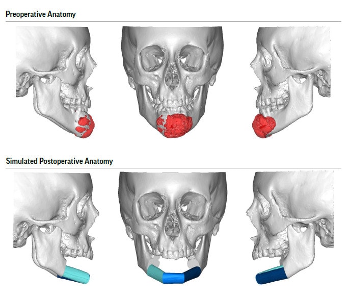 mandibulectomy surgical procedure
