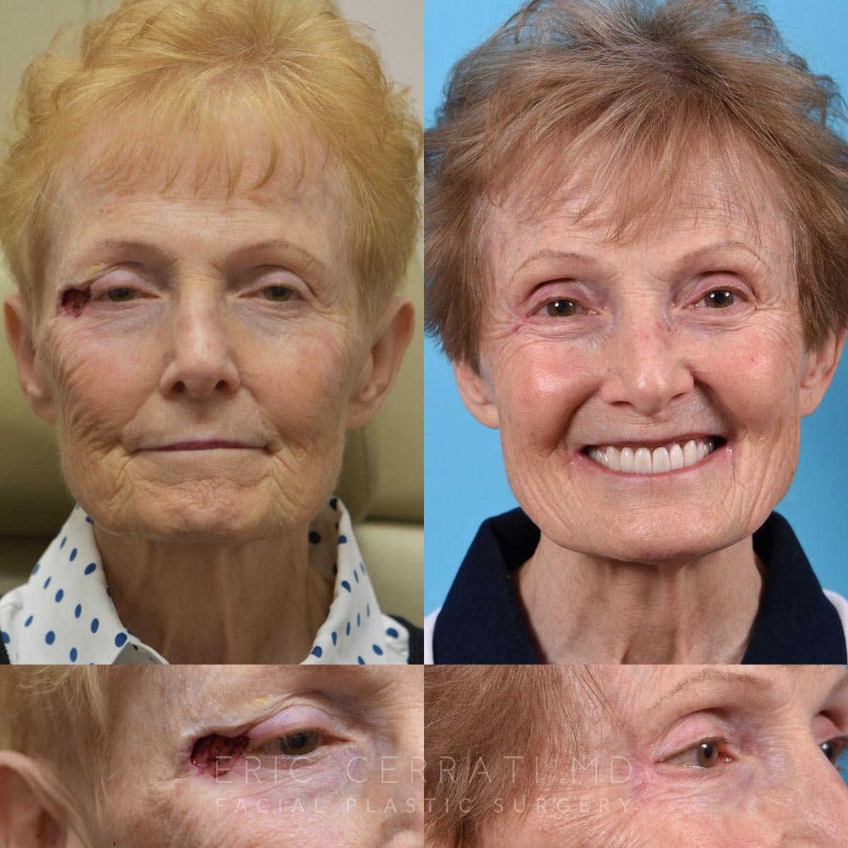 speech therapy after jaw surgery