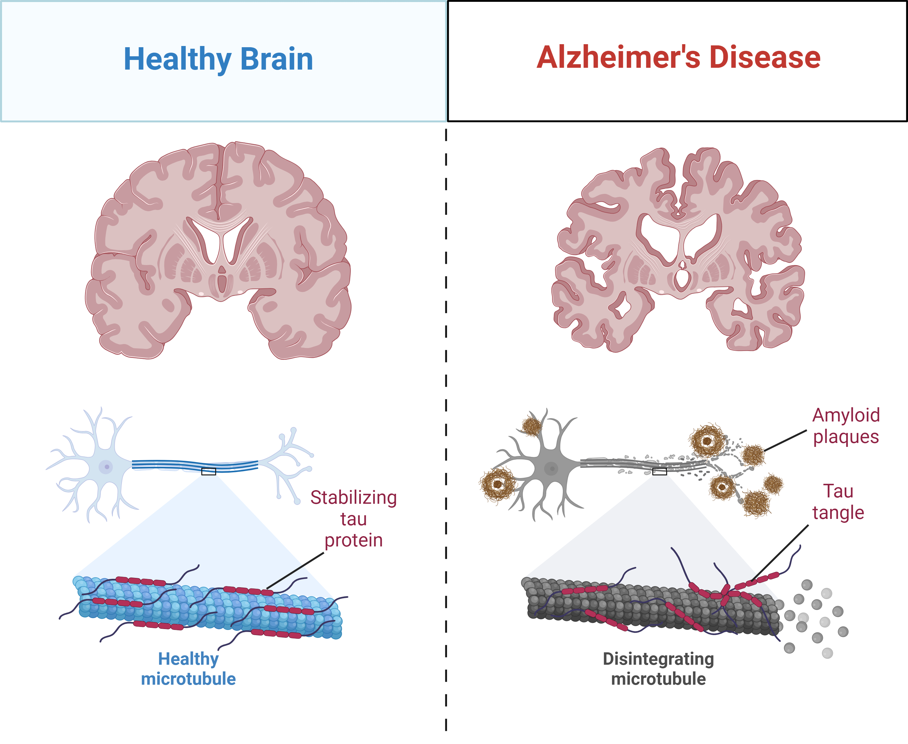 Alzheimer's disease brain research
