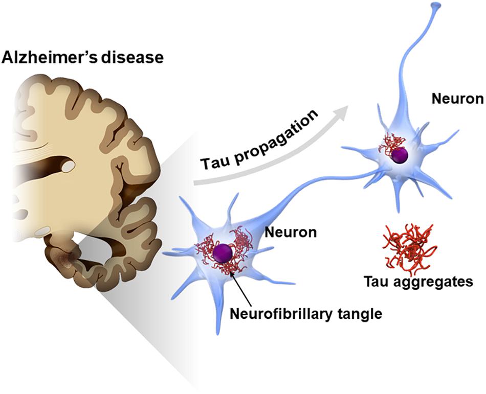 Tau protein aggregates Alzheimer's