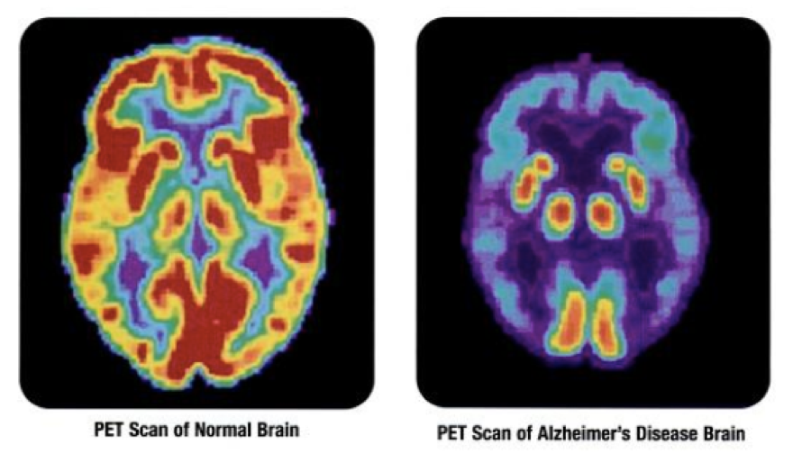 Brain PET imaging Alzheimer's