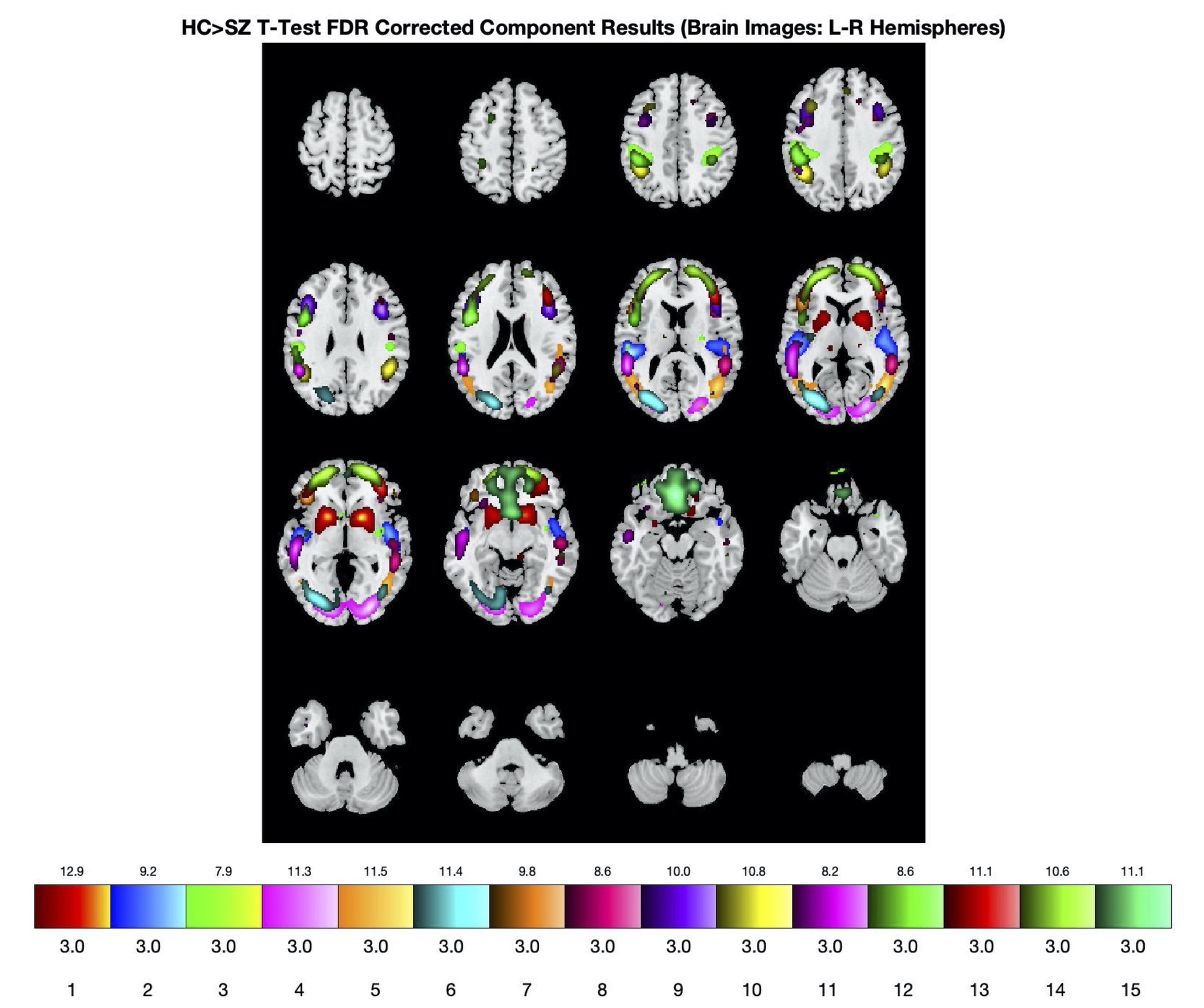 fMRI functional brain connectivity scan