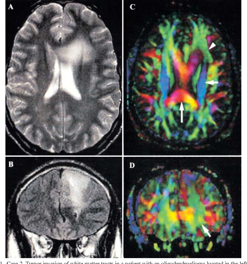 diffusion MRI white matter tracts