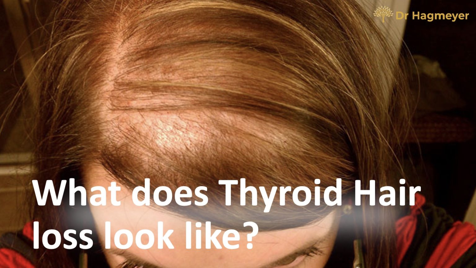 Stop Thyroid Hair Loss: A Practical Guide for 21-Year-Olds