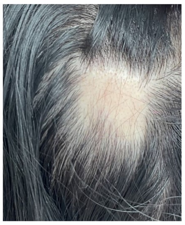 Hashimoto thyroiditis alopecia