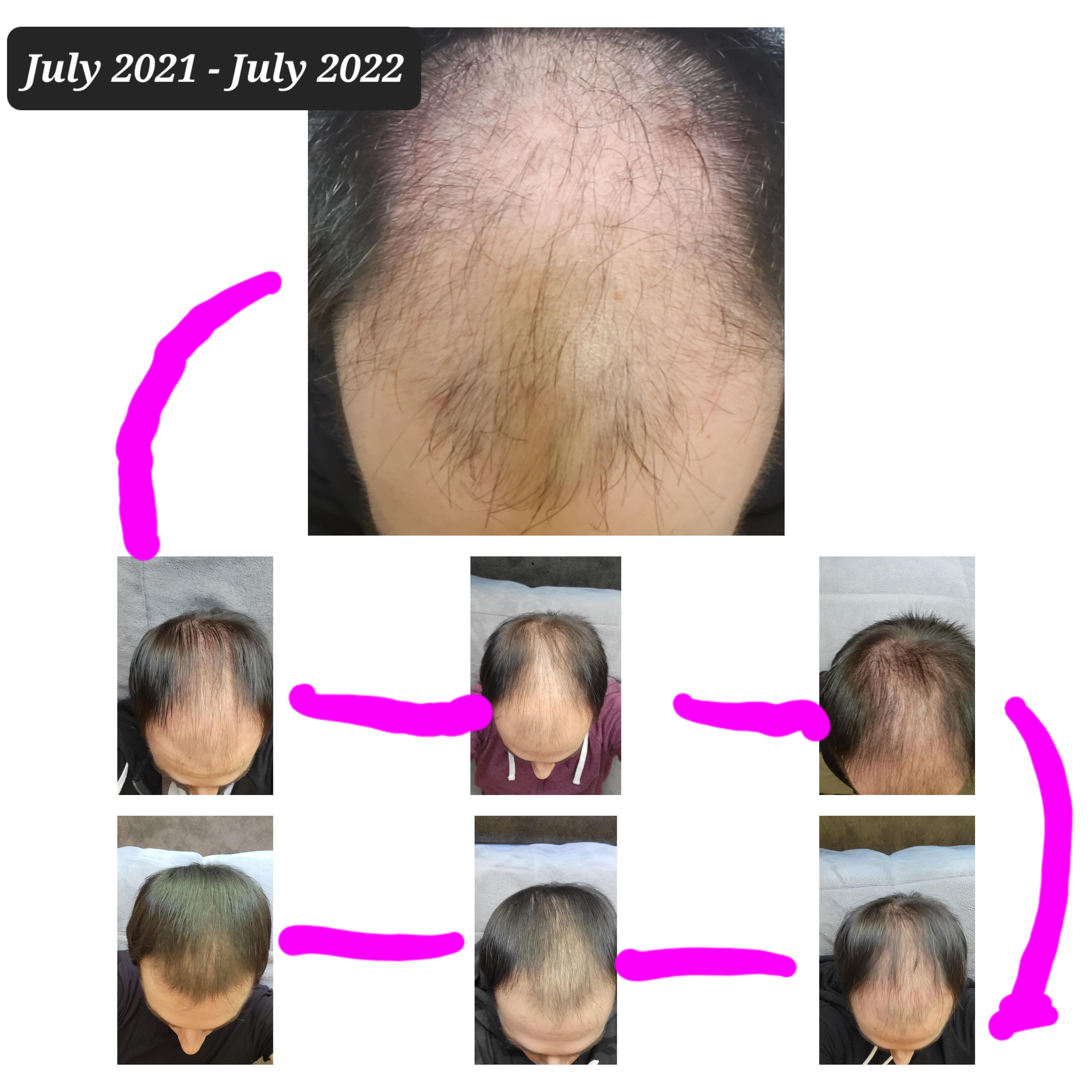 Hair regrowth timeline