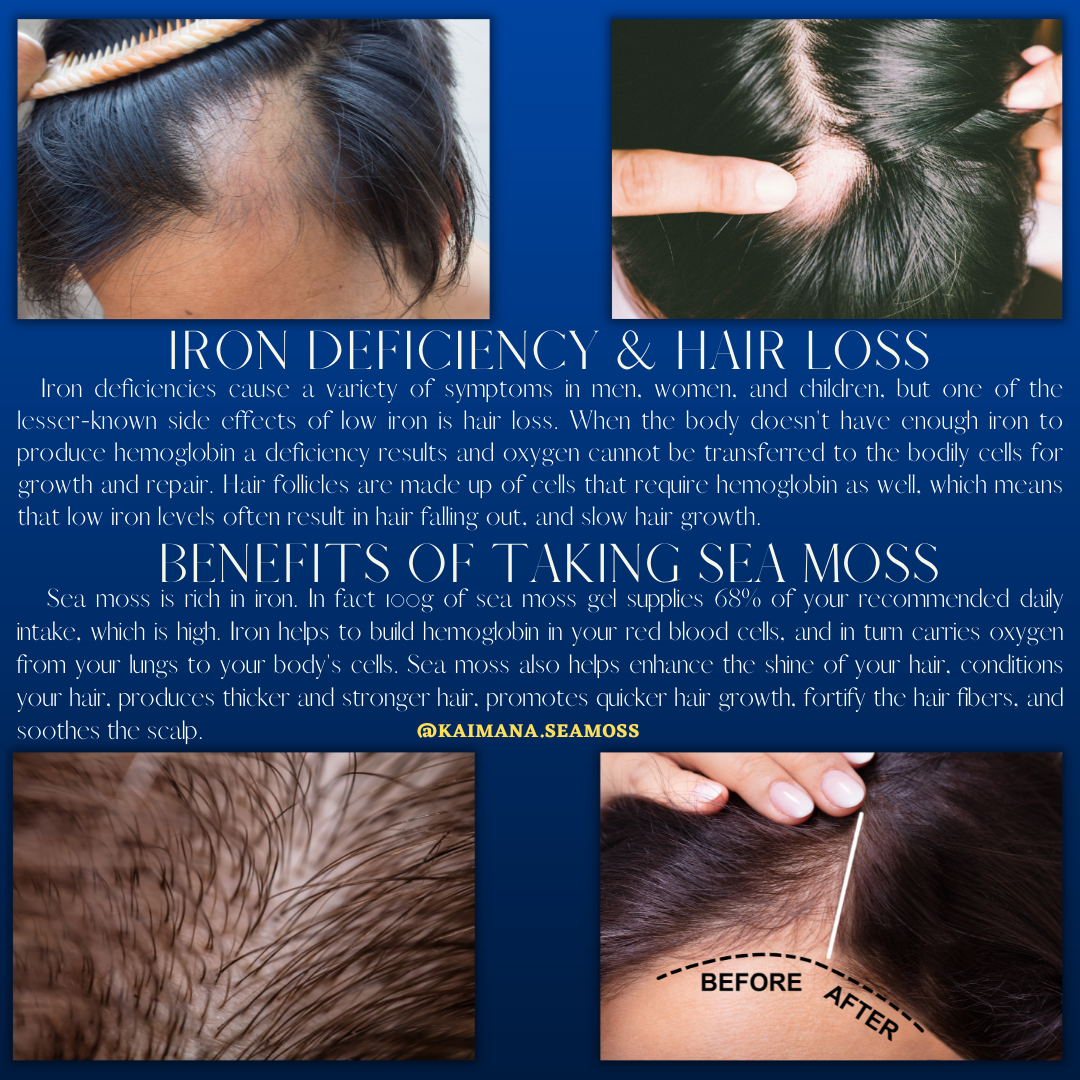 Iron deficiency hair loss