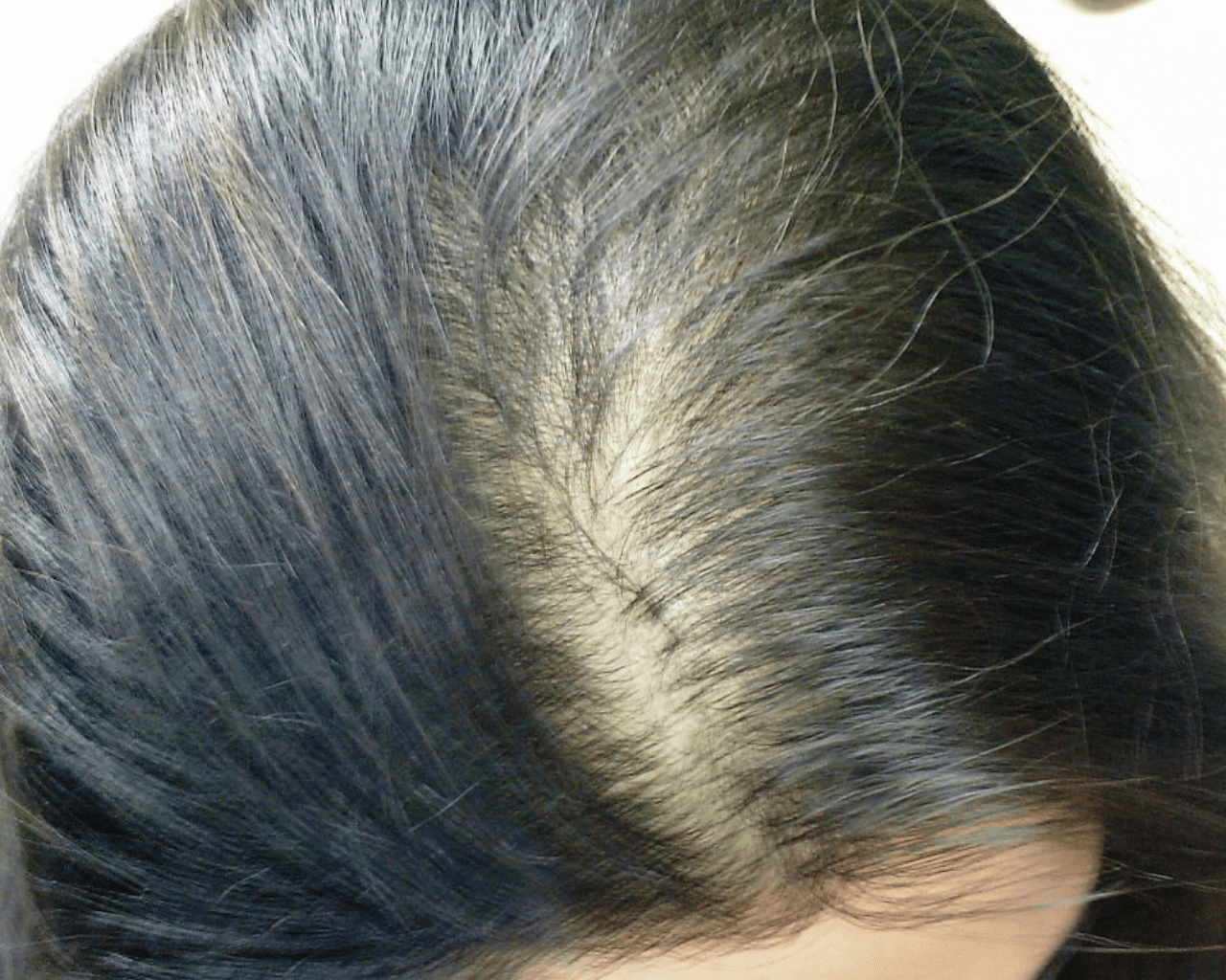 Telogen effluvium thyroid