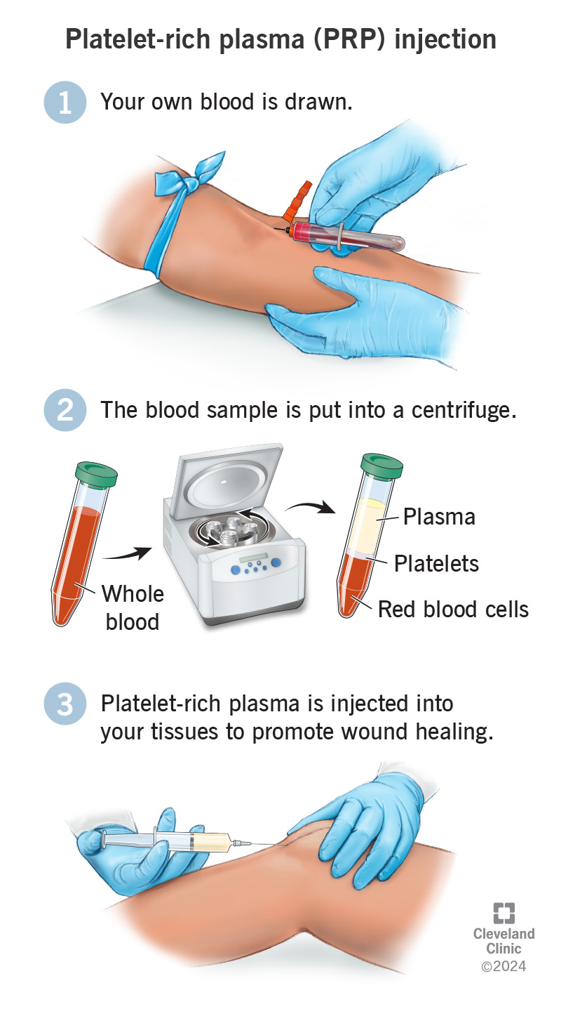 Platelet-rich plasma PRP