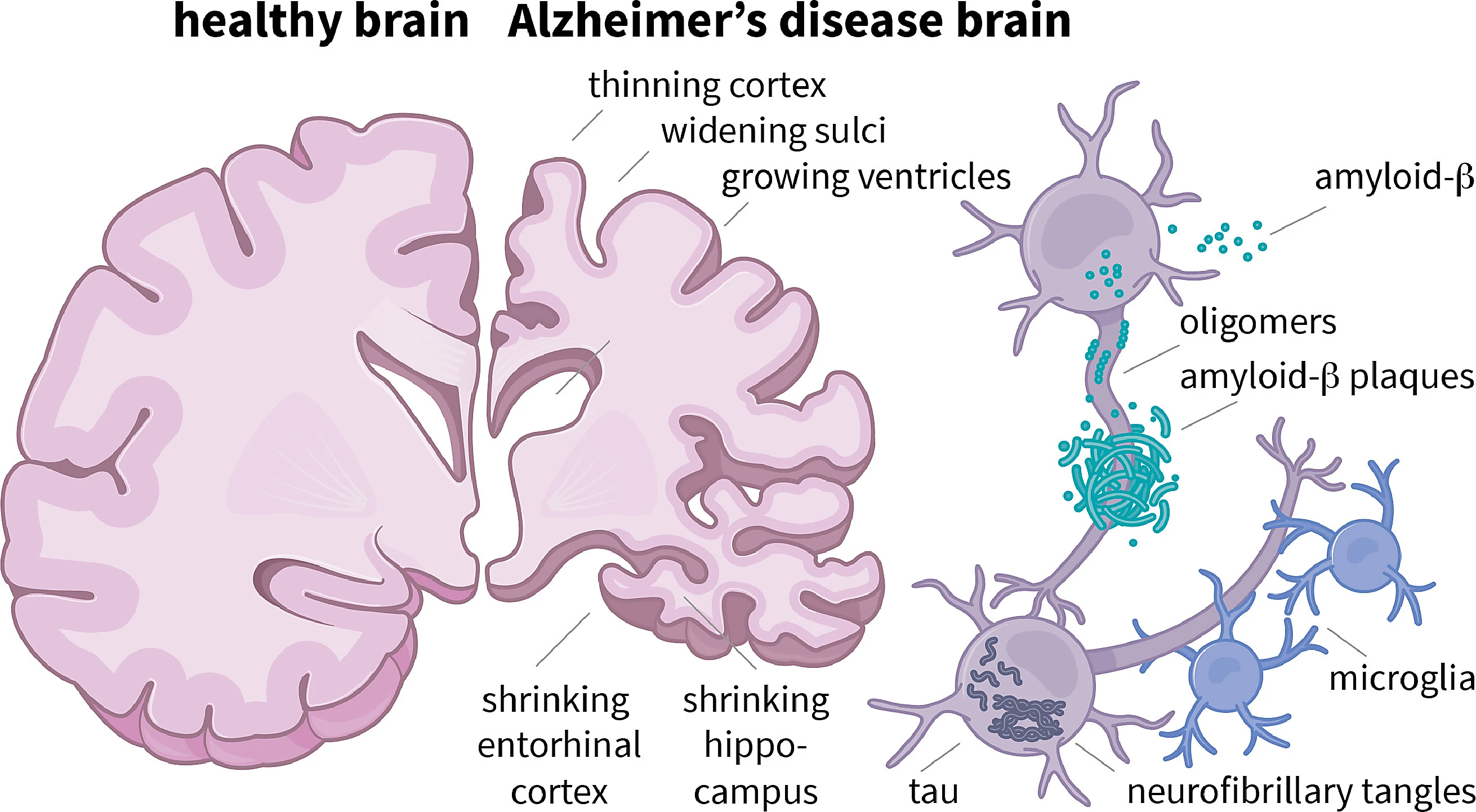 Alzheimer's amyloid-beta plaques