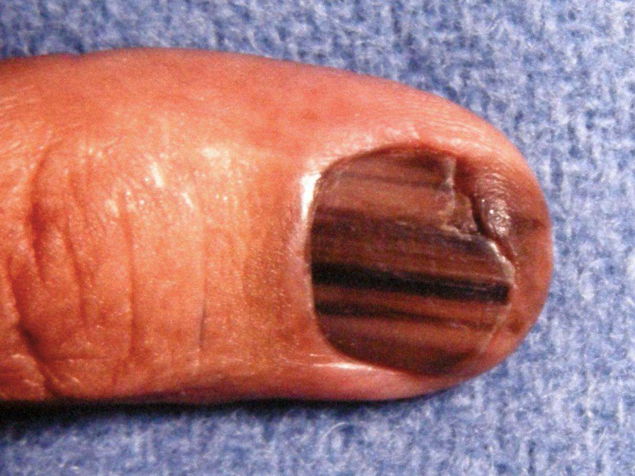 The Line on My Pinky Nail: A Subungual Melanoma Story