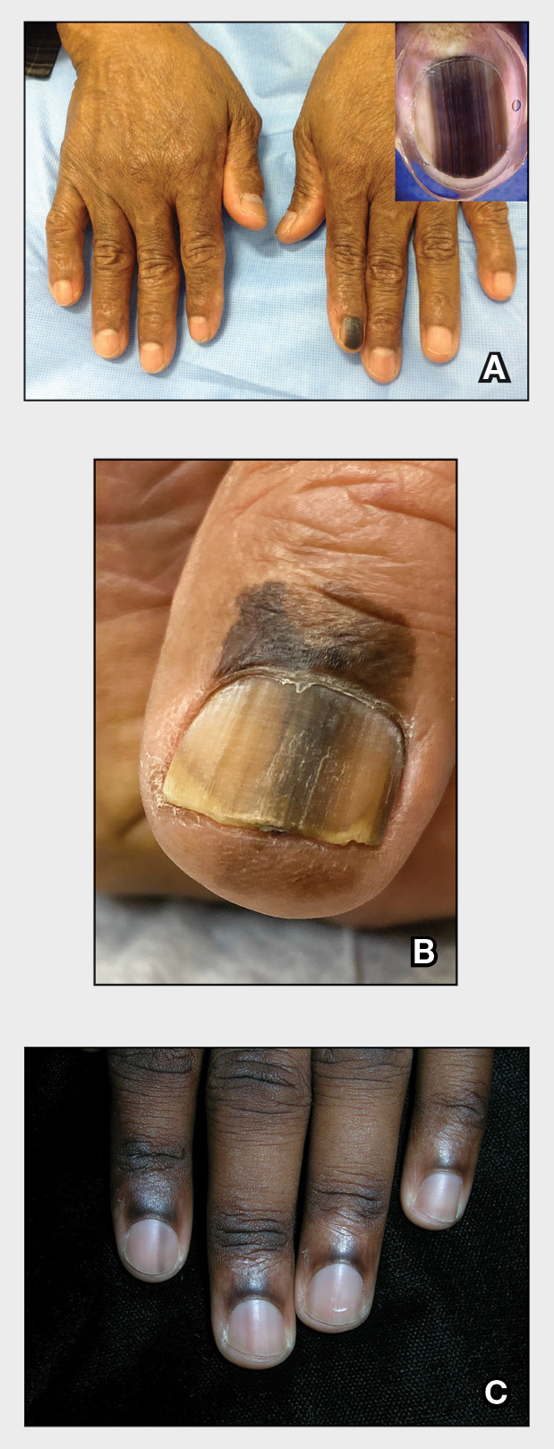 longitudinal melanonychia