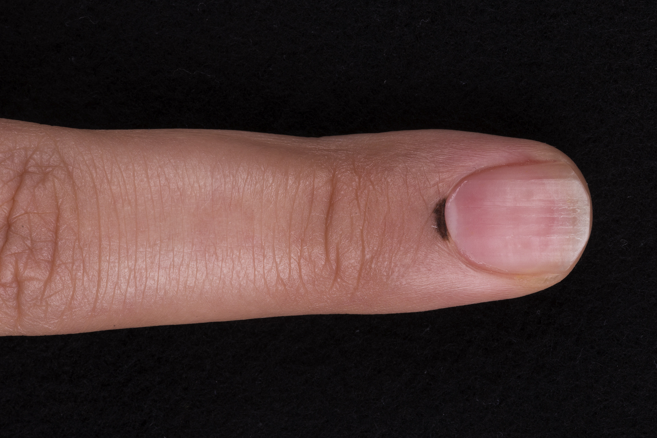 Hutchinson sign nail