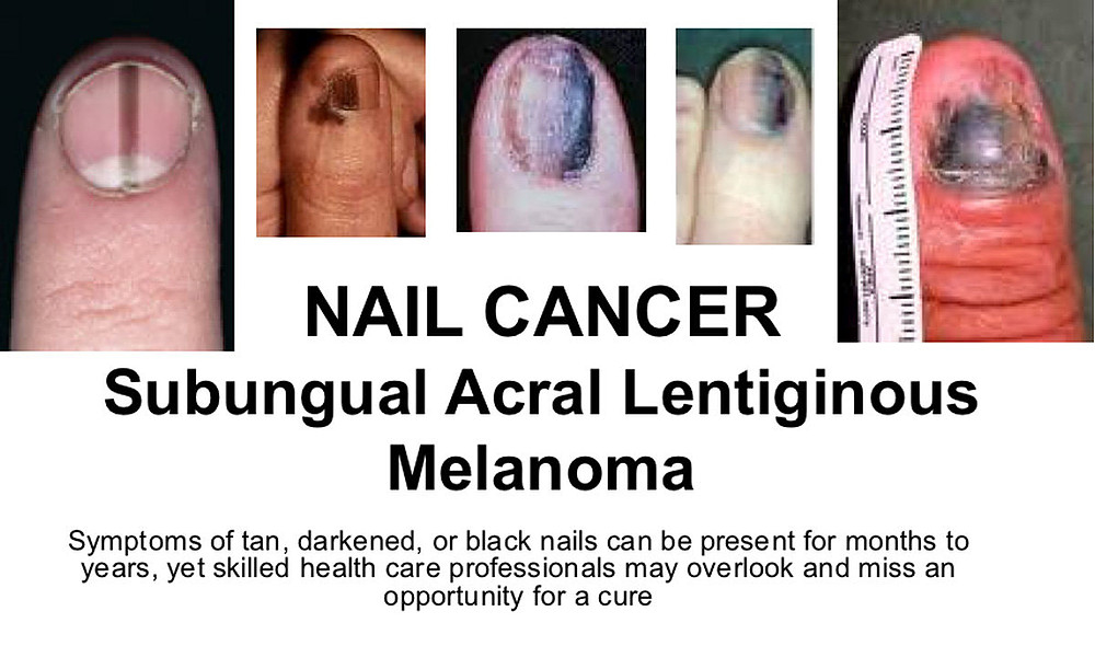 pinky nail melanoma
