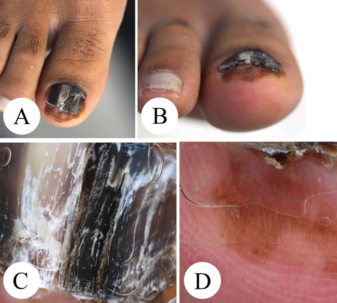 nail cancer dermatoscope