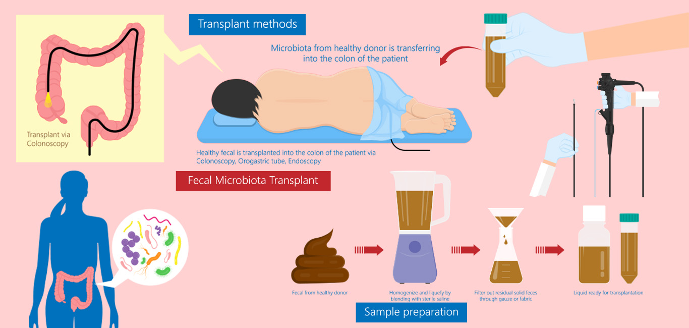 fecal microbiota transplantation FMT