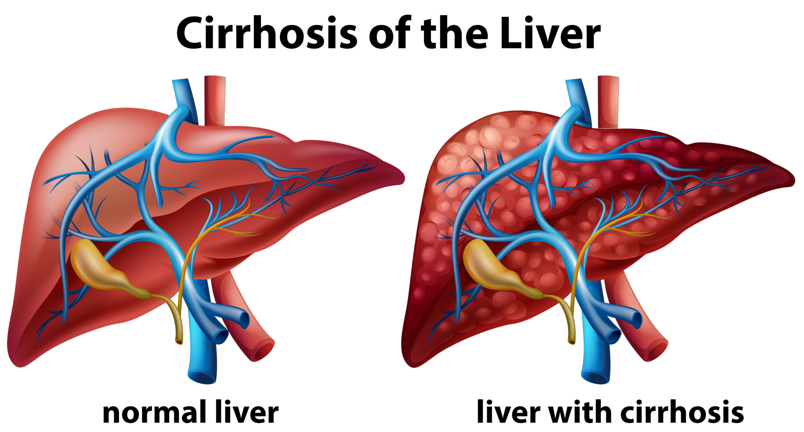 human liver cirrhosis diagram