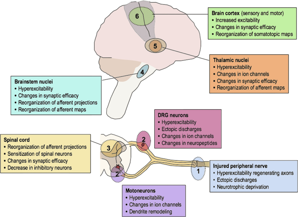 cortical hyperexcitability brain