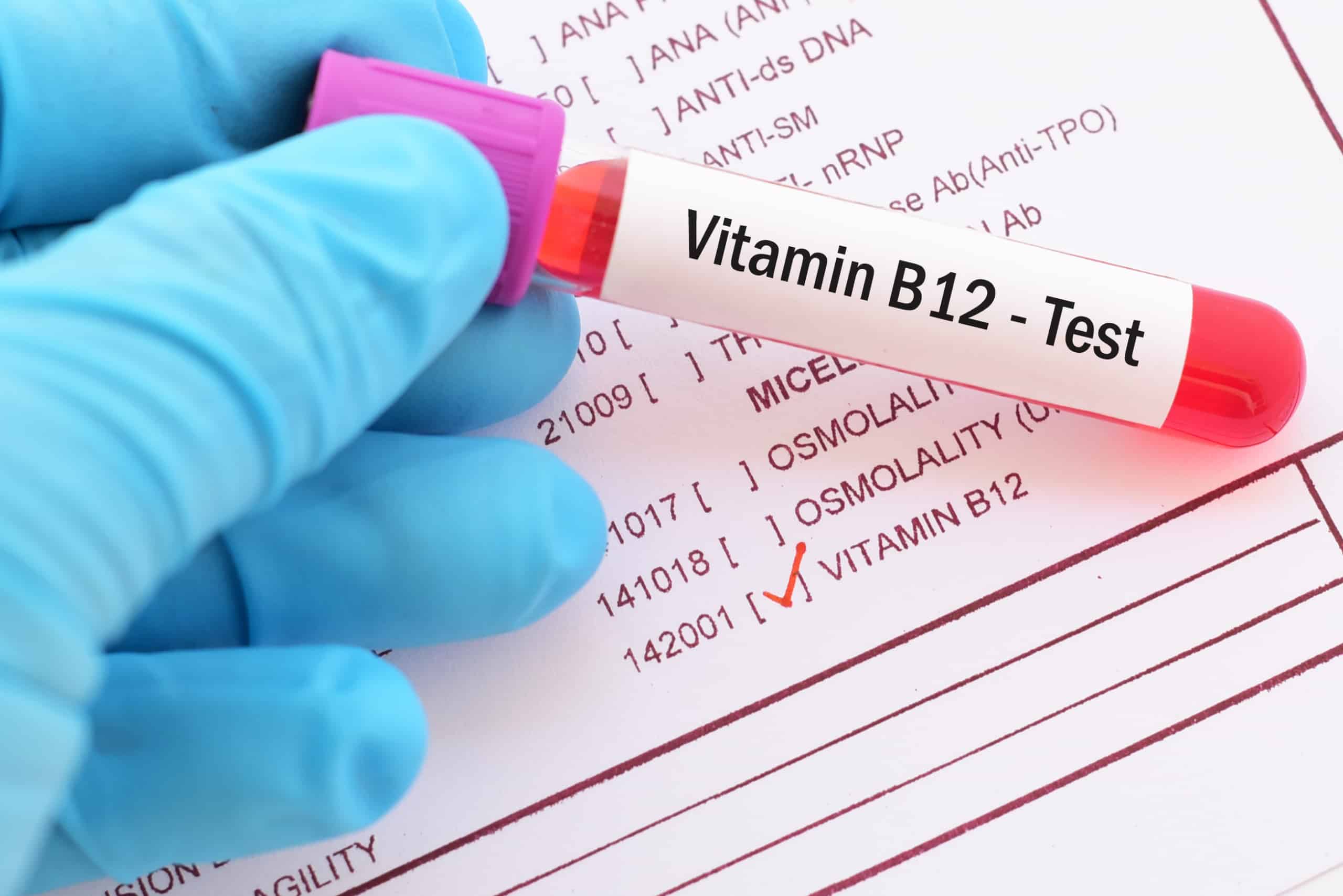 B12 blood test vial