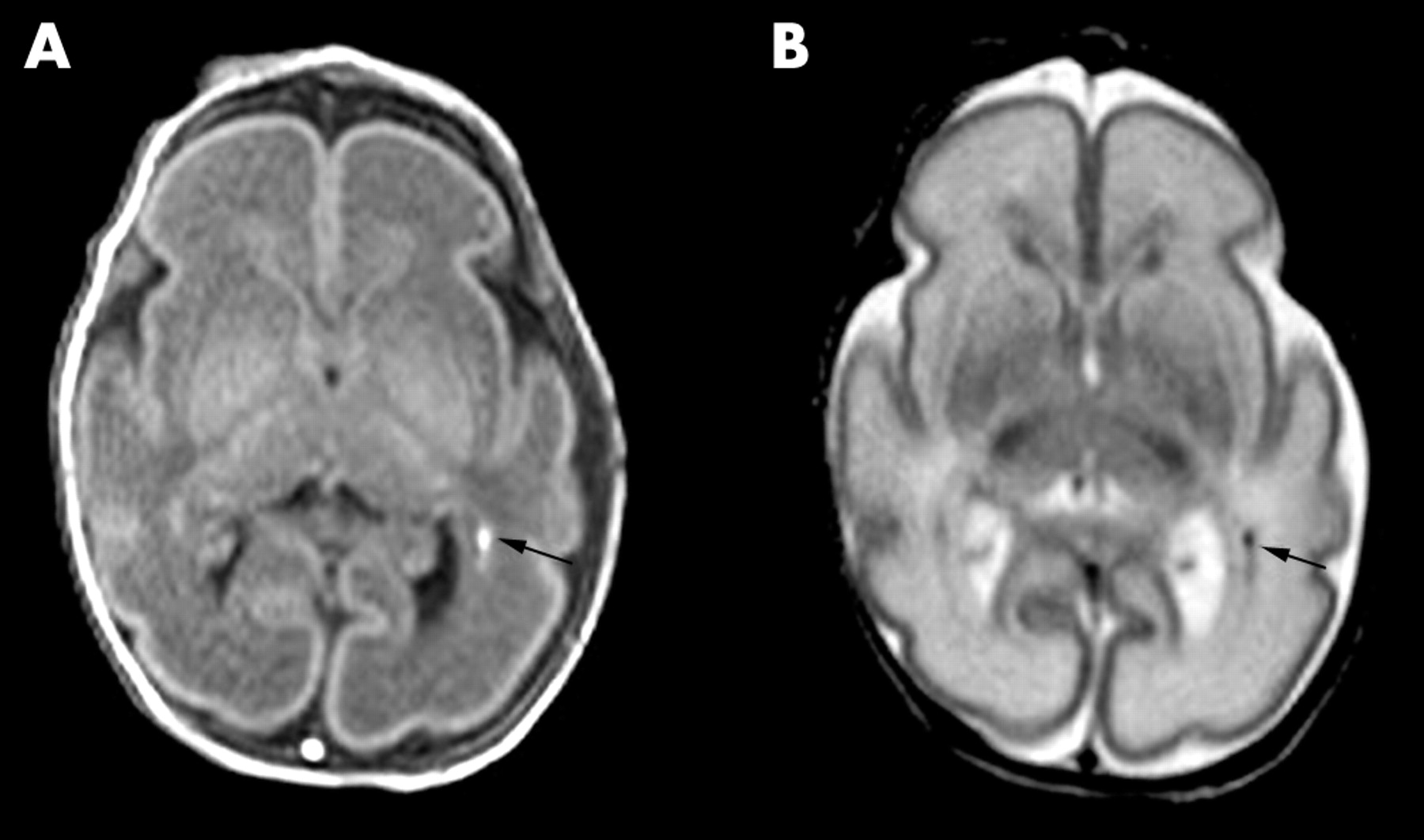 Baby brain injury MRI