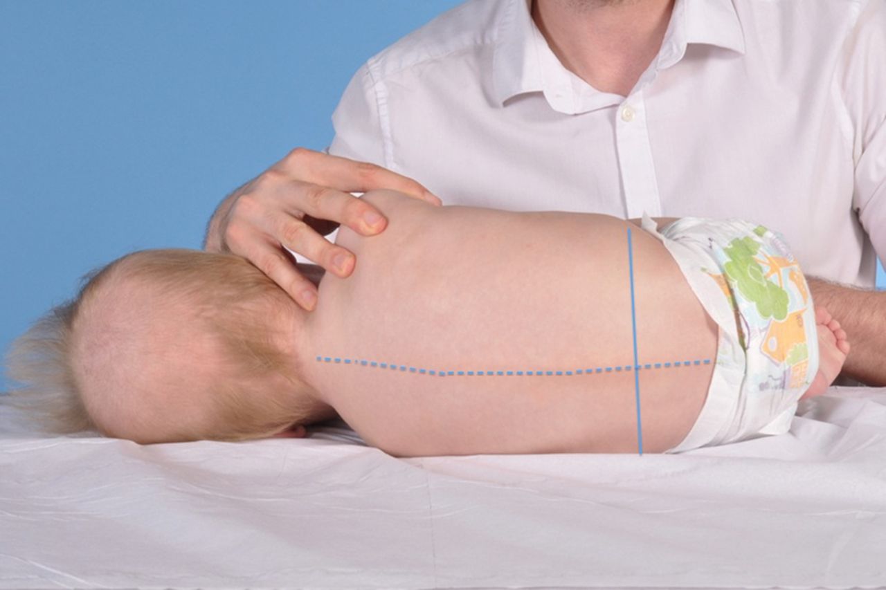 Lumbar puncture infant