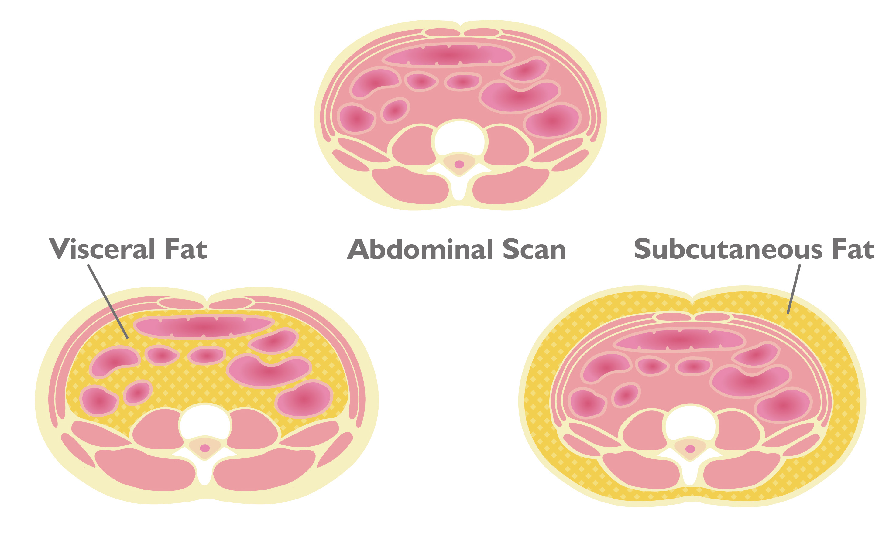 visceral fat abdomen