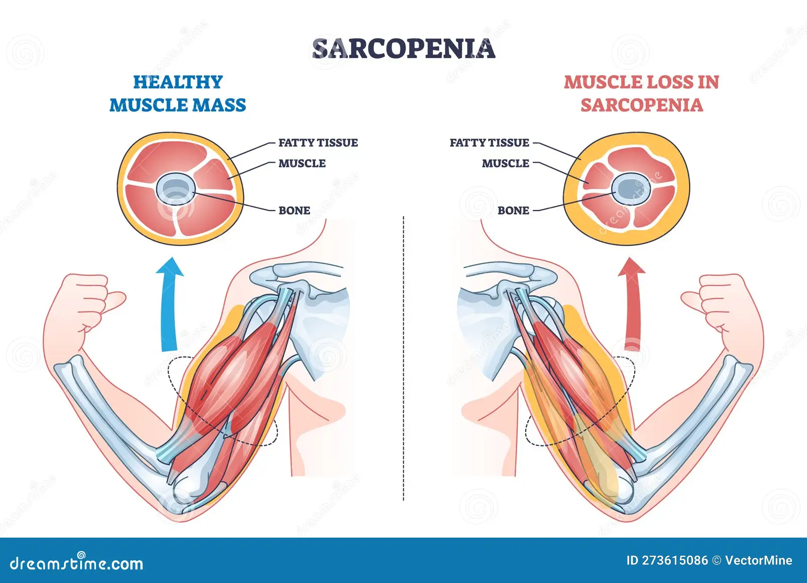 sarcopenia muscle loss