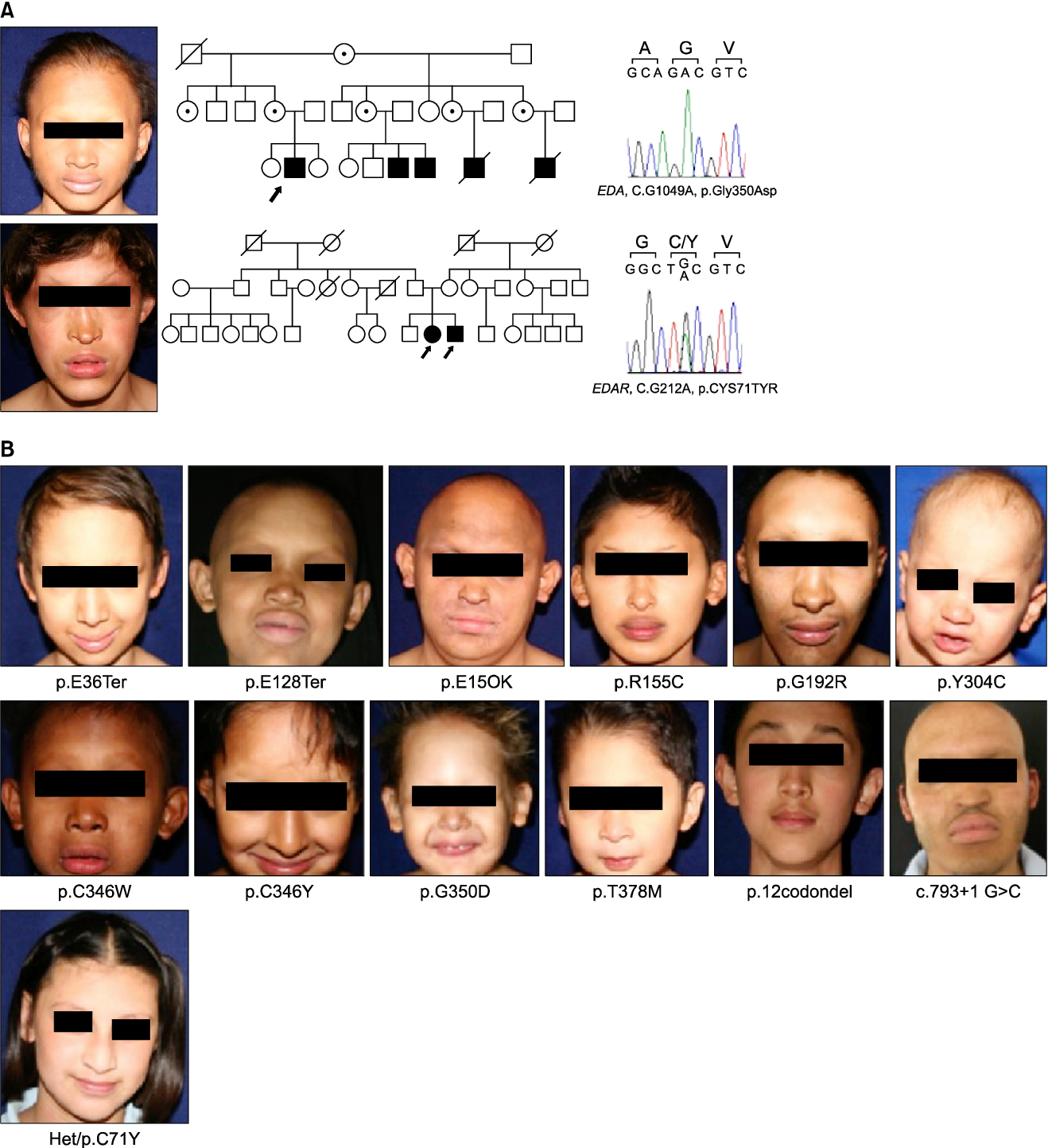 EDAR gene hair thickness