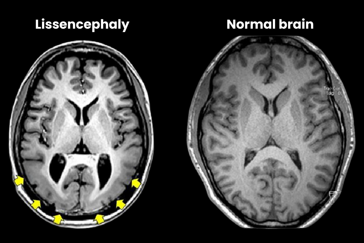 lissencephaly smooth brain MRI
