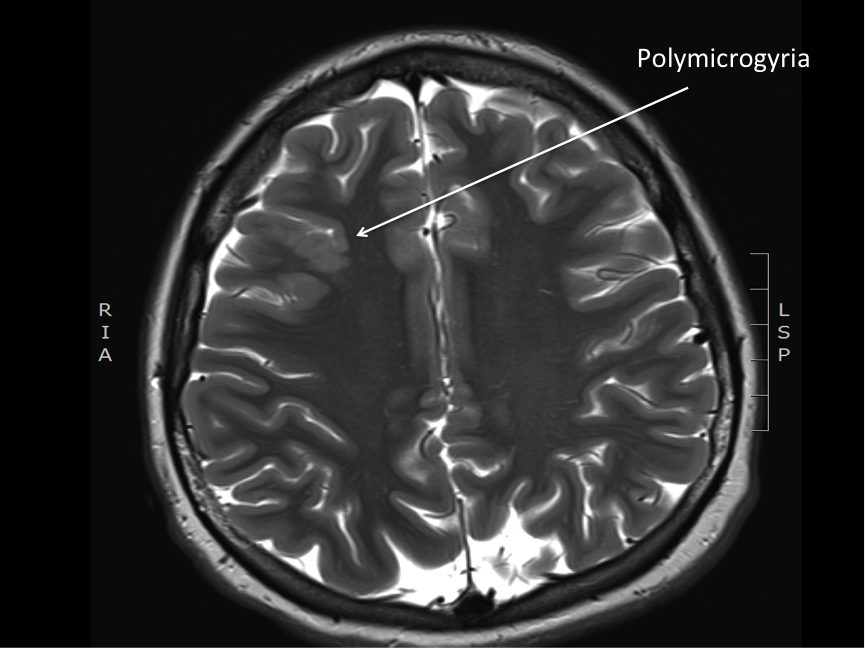 polymicrogyria brain pathology